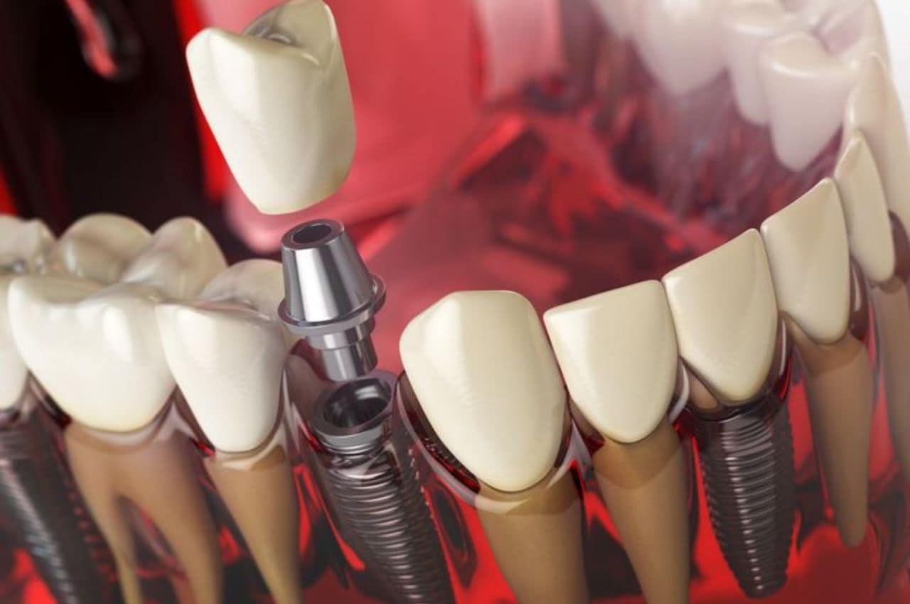 Dental Implants are the Best Choice for Tooth Replacement in London